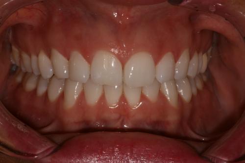 Teeth whitening after
