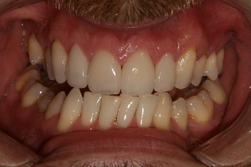 Porcelain veneers and teeth whitening after