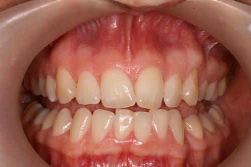 Teeth whitening before