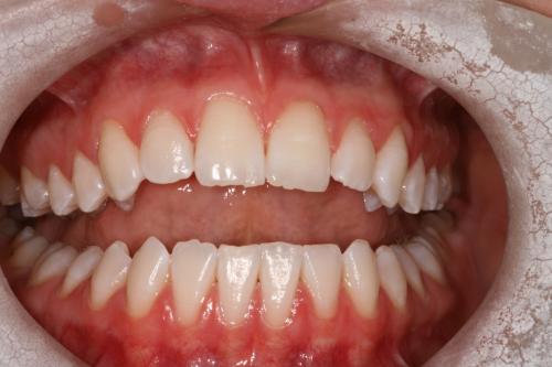 Teeth whitening after