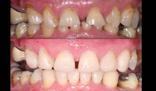 Contemporary Management of Tooth Wear
