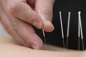 Western Medical Acupuncture