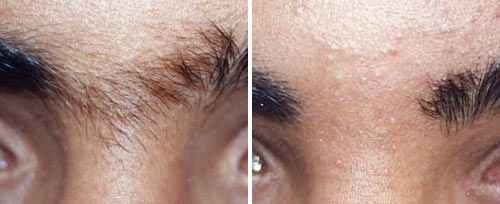 Eyebrow hair reduction before and after treaments