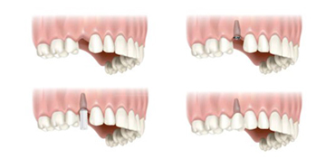 Single Dental Implants
